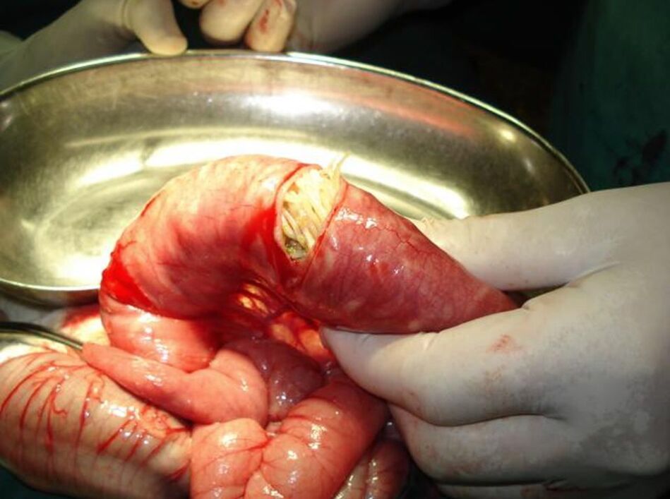 Les oxyures dans l'intestin humain