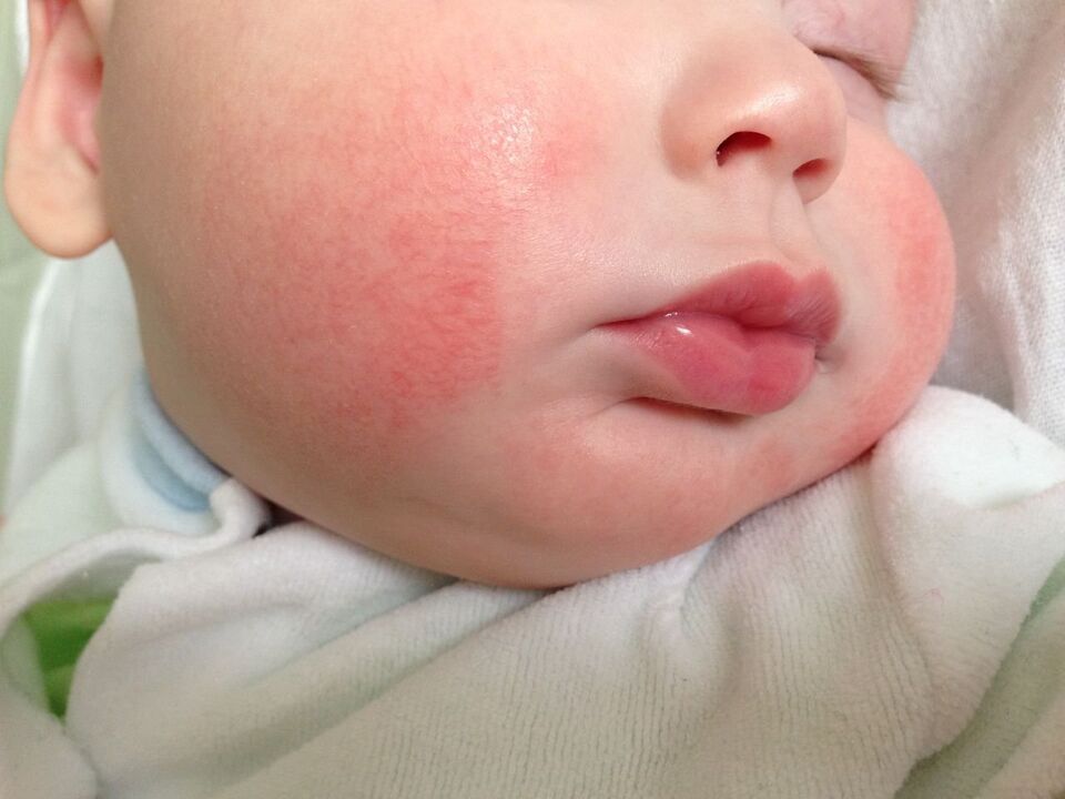 Un signe de vers chez un enfant est l'urticaire allergique. 